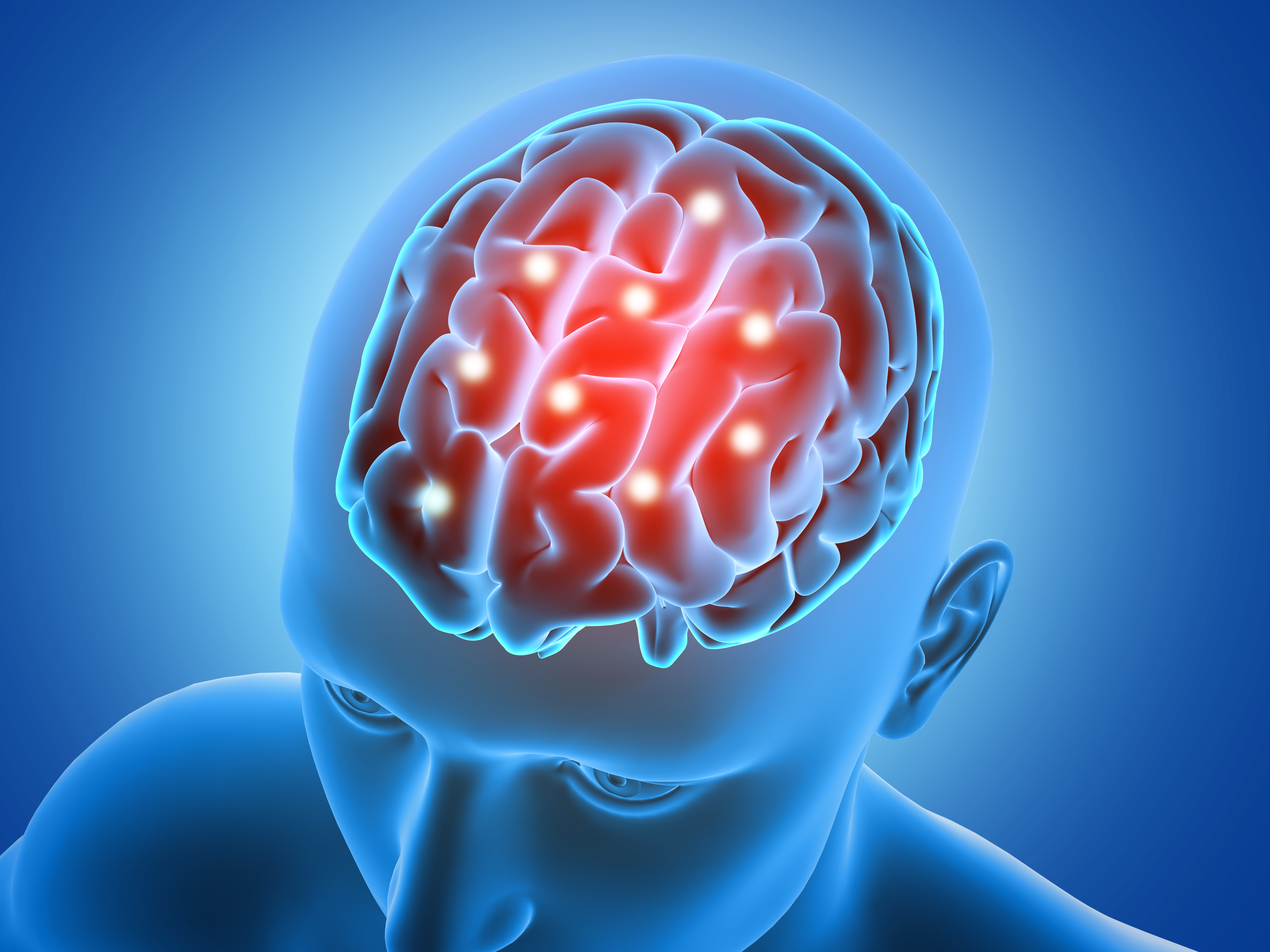 ACV o derrame cerebral: las señales de alerta que debes reconocer y cómo actuar a tiempo