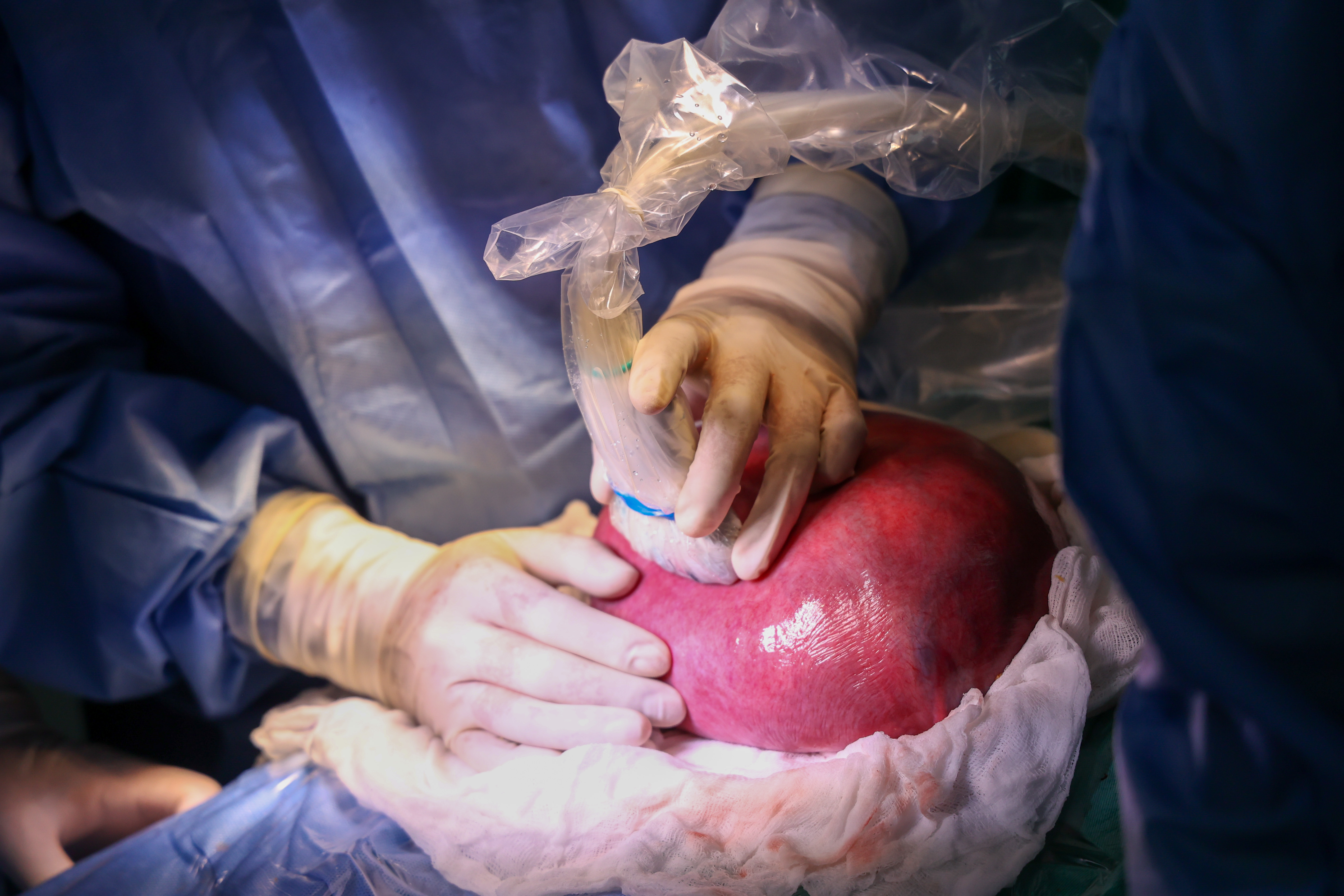 Proeza médica en EsSalud: Operan a bebé dentro del útero en Hospital Rebagliati y el embarazo sigue con éxito