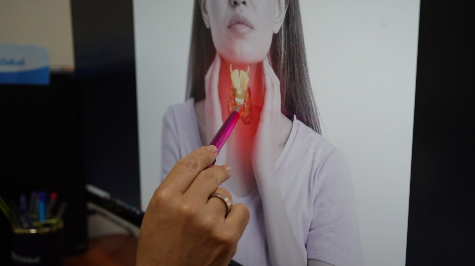 EsSalud alerta: enfermedades de la tiroides golpean más a mujeres  y solo el 10% de nódulos es cancerígeno