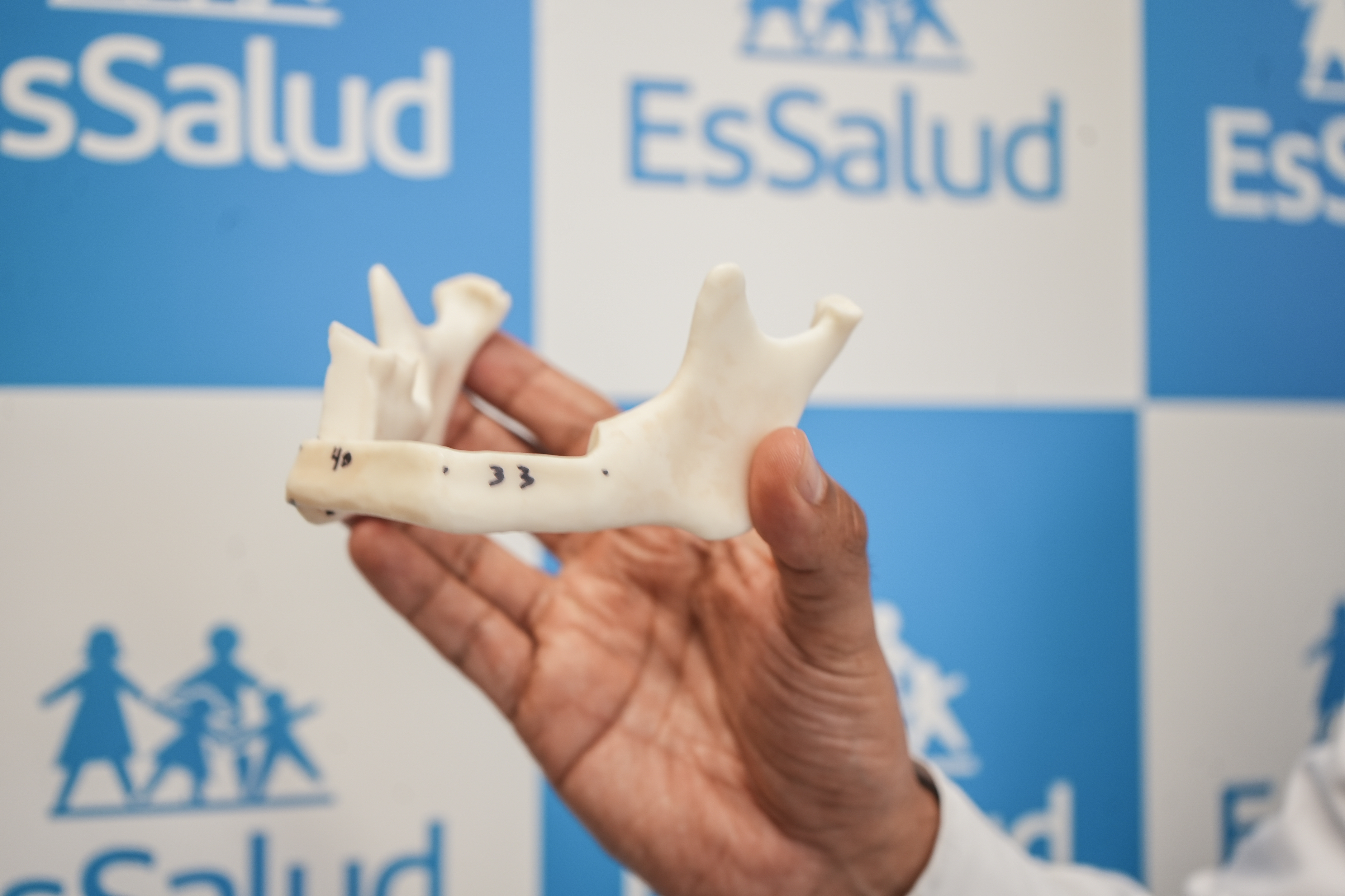 Proeza médica: EsSalud reconstruye mandíbula de paciente con hueso de su pierna