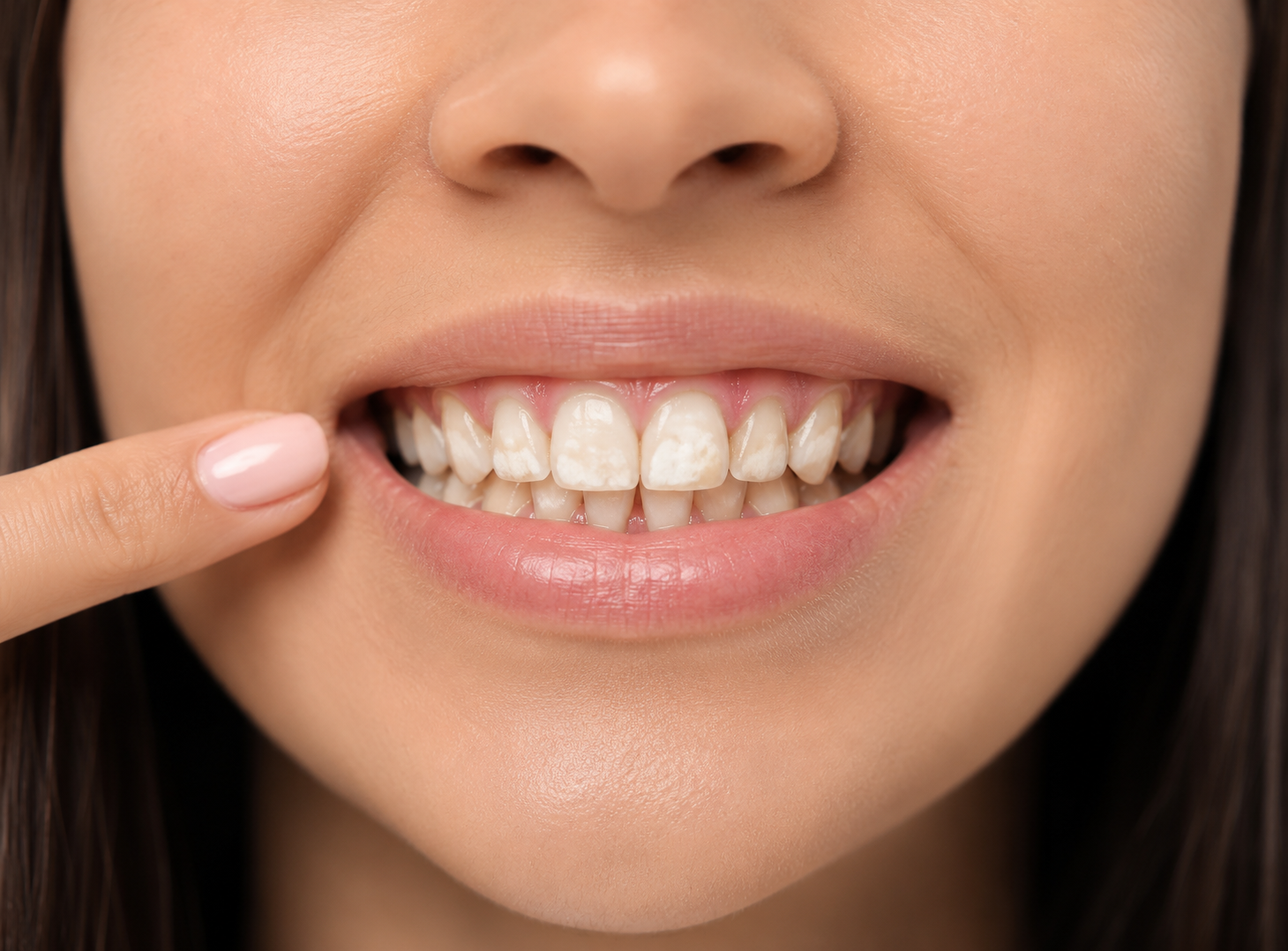 ¿Manchas blancas en tus dientes? Podrían ser una señal temprana de caries
