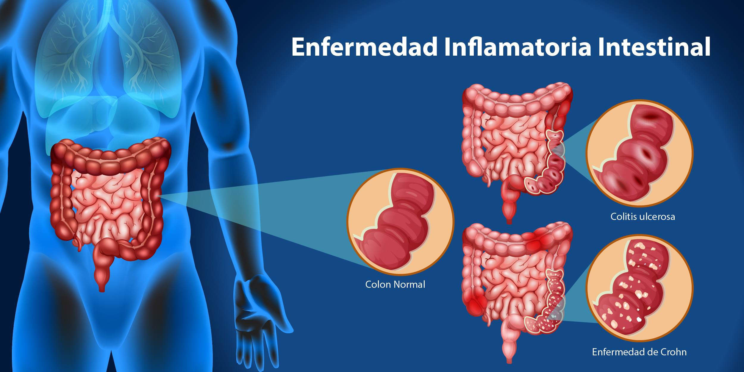 La innovación en salud hoy permite que los pacientes peruanos con Enfermedad Inflamatoria Intestinal alcancen una mayor calidad de vida