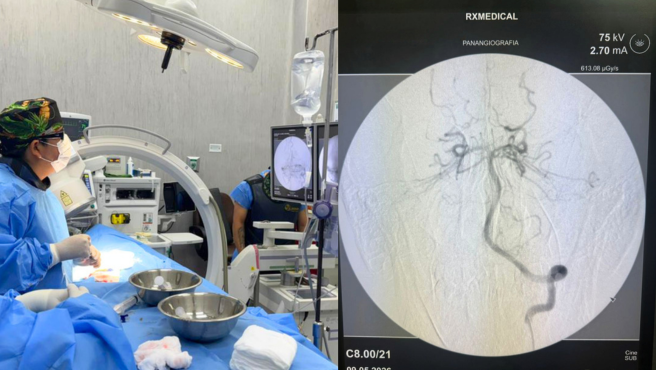 Vanguardia médica: Hospital Santa Rosa de Pueblo Libre realiza su primer neurointervencionismo endovascular