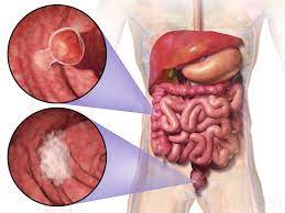 Uno de los cánceres más agresivos del país es el de colon y es prevenible con la buena alimentación