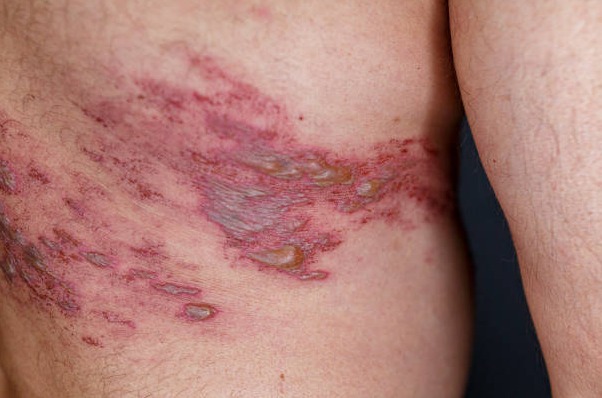 Envejecimiento activo: qué conviene saber sobre el herpes zóster después de los 50 y por qué no debería subestimarse