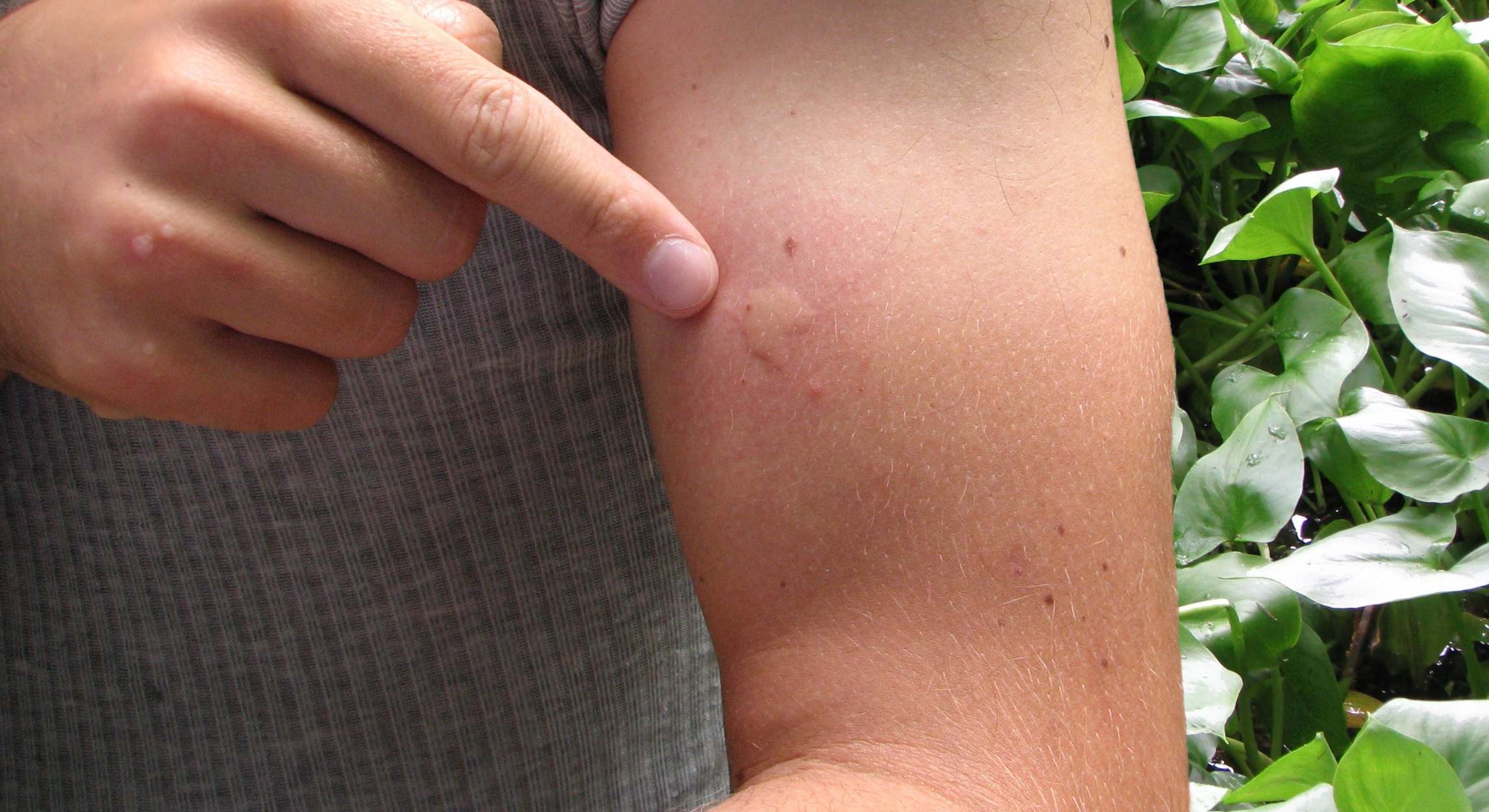 Verano sin picaduras: consejos clave para prevenir riesgos y saber cuándo acudir al médico