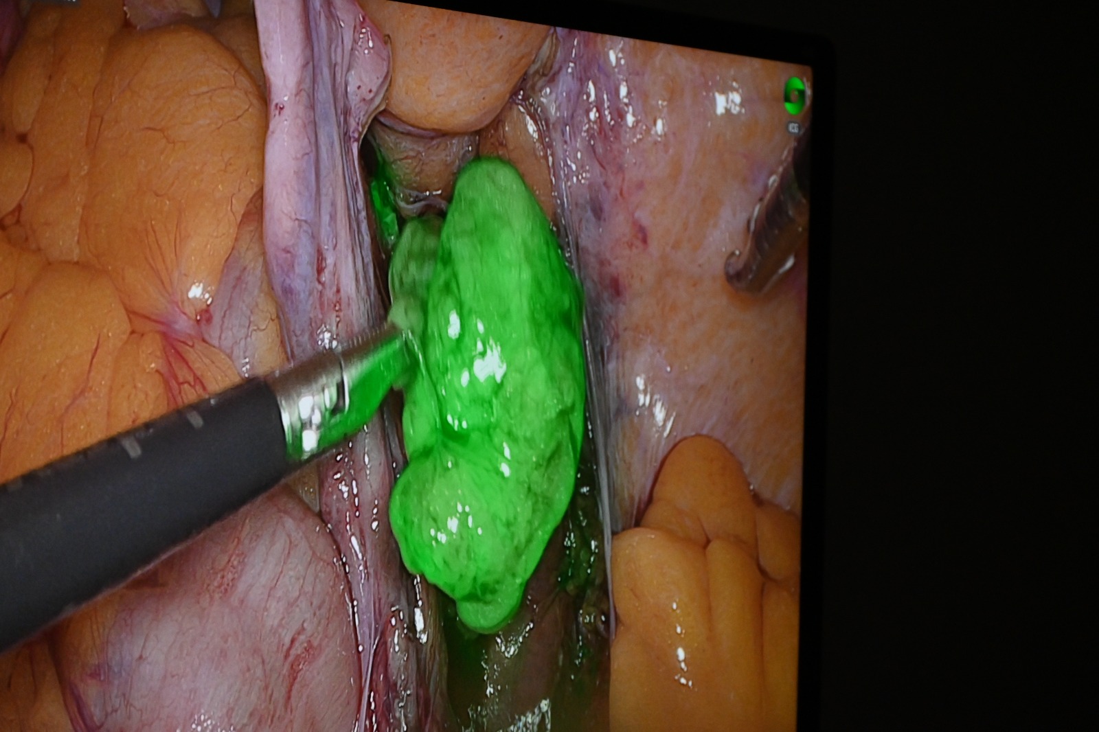 Minsa: oncólogos del Hospital Cayetano Heredia realizan con éxito primera cirugía laparoscópica con sustancia radiactiva