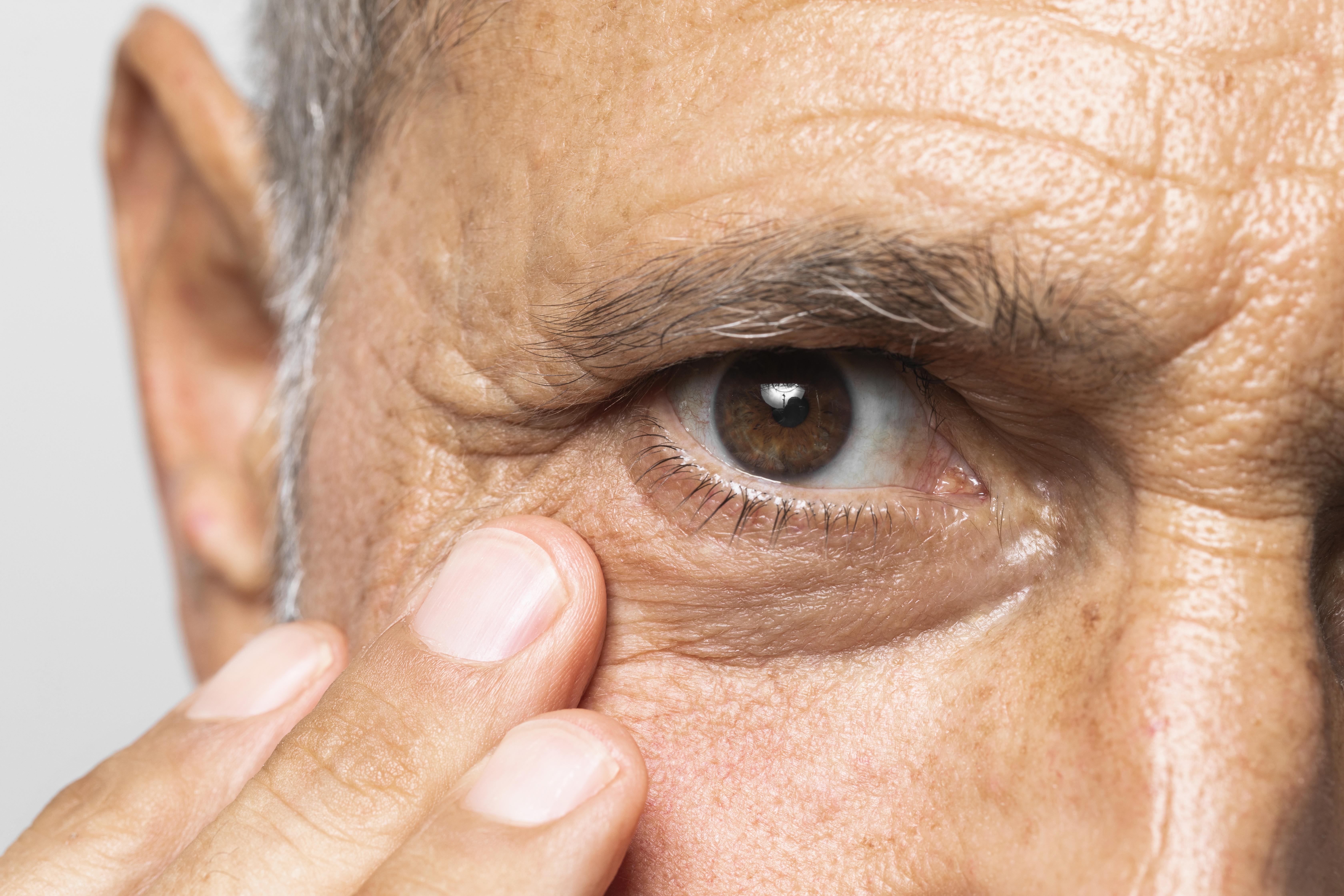 ¿Padeces de glaucoma? Detección y tratamiento