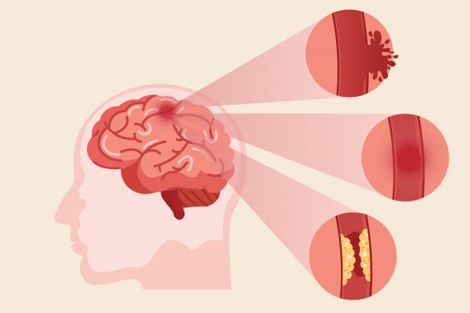 Aumenta a 27 % más los casos de accidentes cerebrovasculares en el Mundo y pudiendo triplicarse en 10 años, asegura especialista.