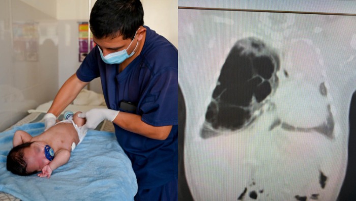 Equipo del INSN Breña salva la vida a neonato ancashino tras compleja cirugía pulmonar