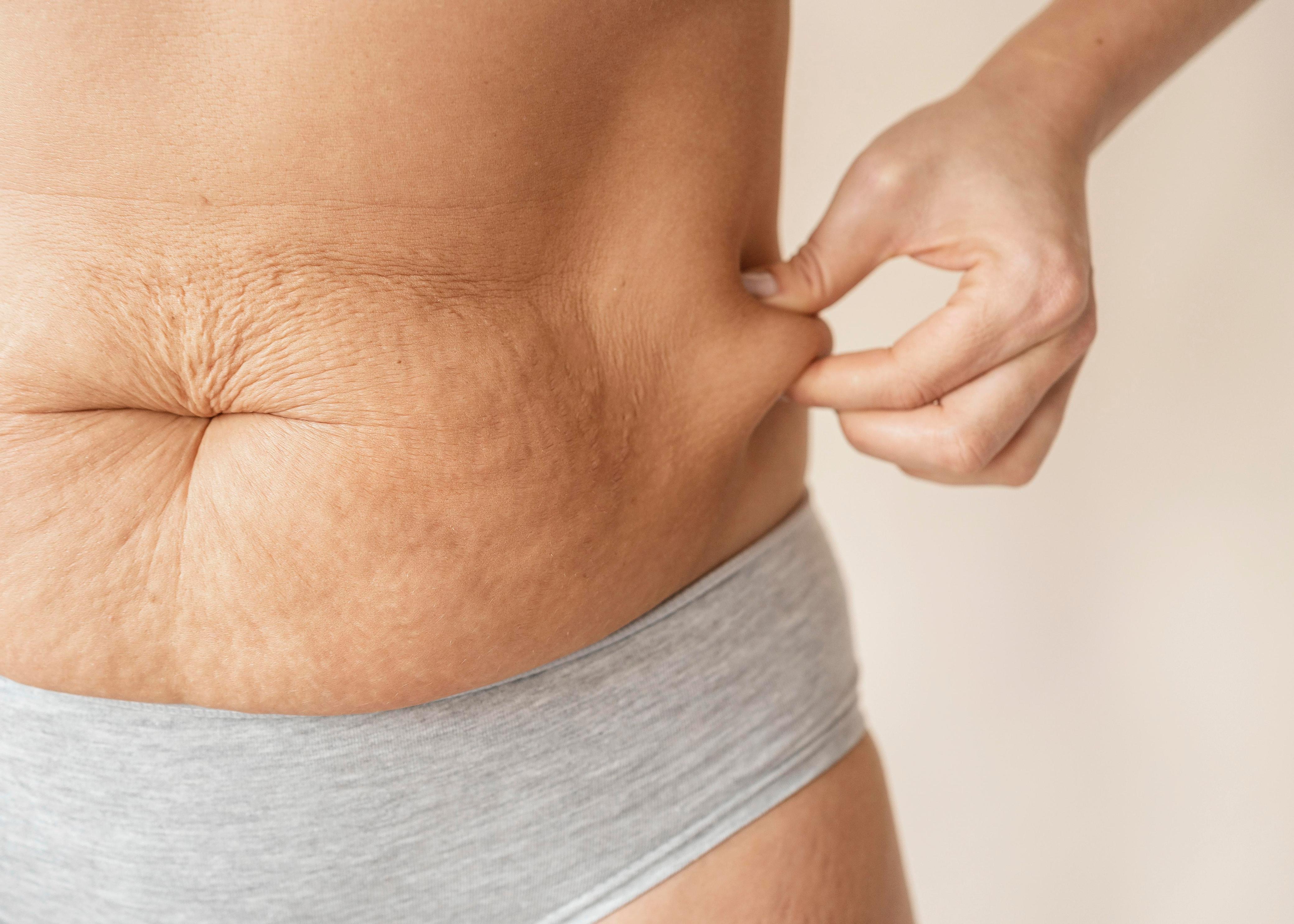 ¿Flacidez abdominal? Lo que debes saber antes de elegir un tratamiento