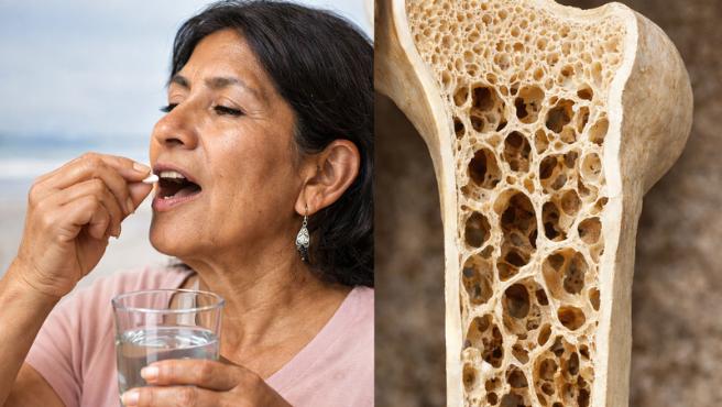 Minsa alerta sobre el riesgo de osteoporosis asociada al uso inadecuado de medicamentos