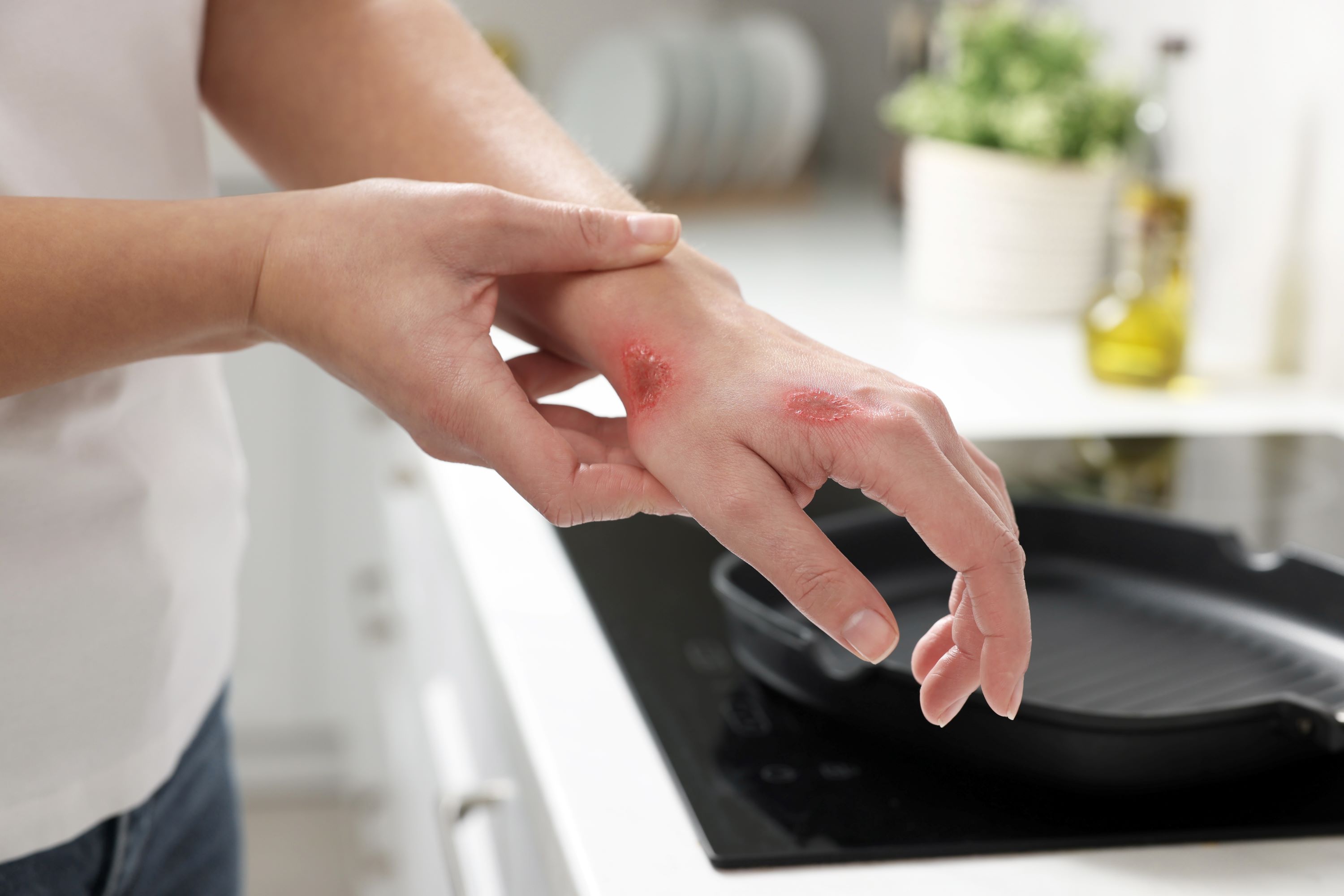 ¿Cómo actuar en caso de accidentes en casa?