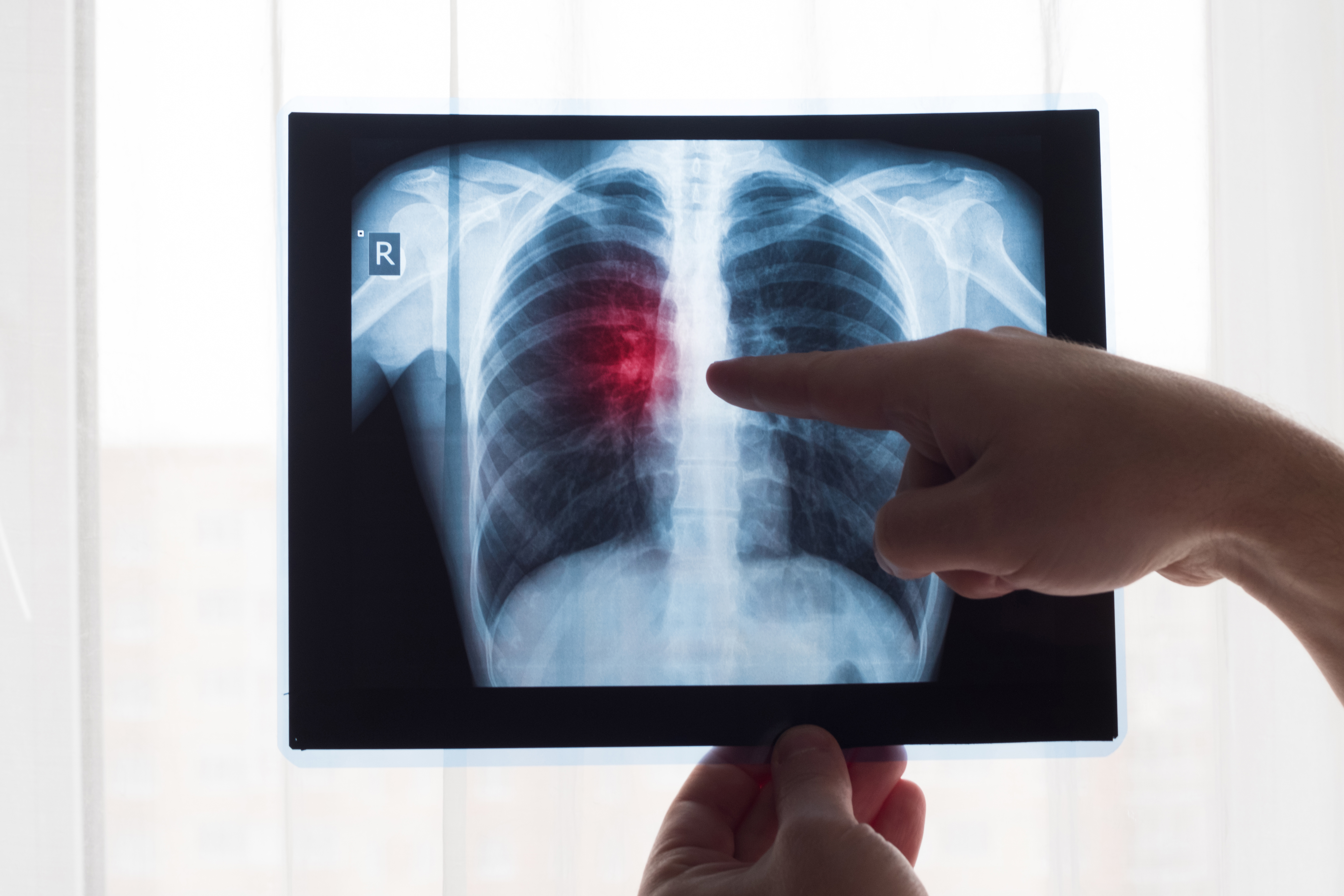 Cáncer de Pulmón: esta neoplasia representa el 5% de todas las causas de cáncer en Perú