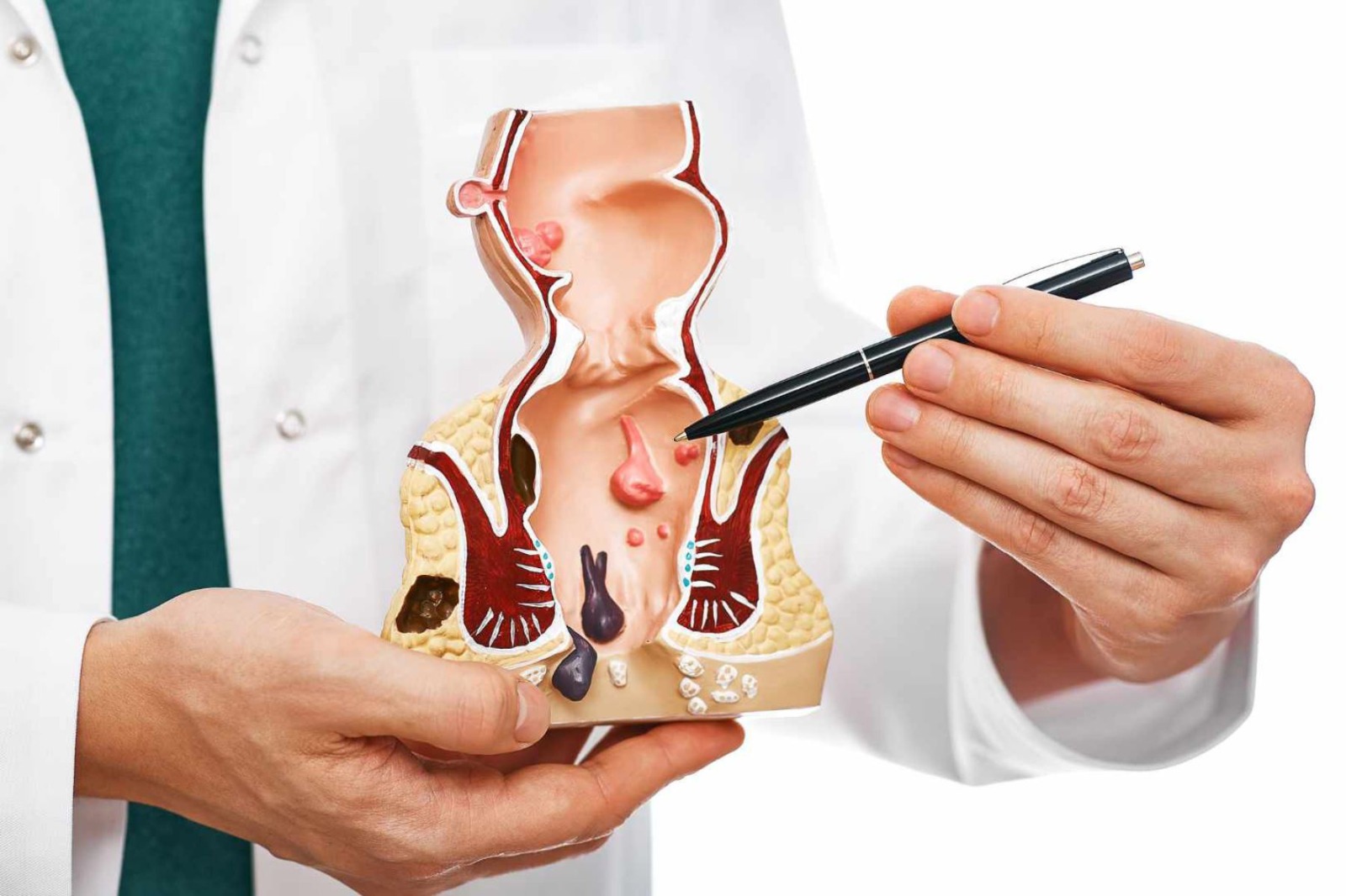 Cáncer de colon: mitos peligrosos que ponen en riesgo tu salud y retrasan el diagnóstico