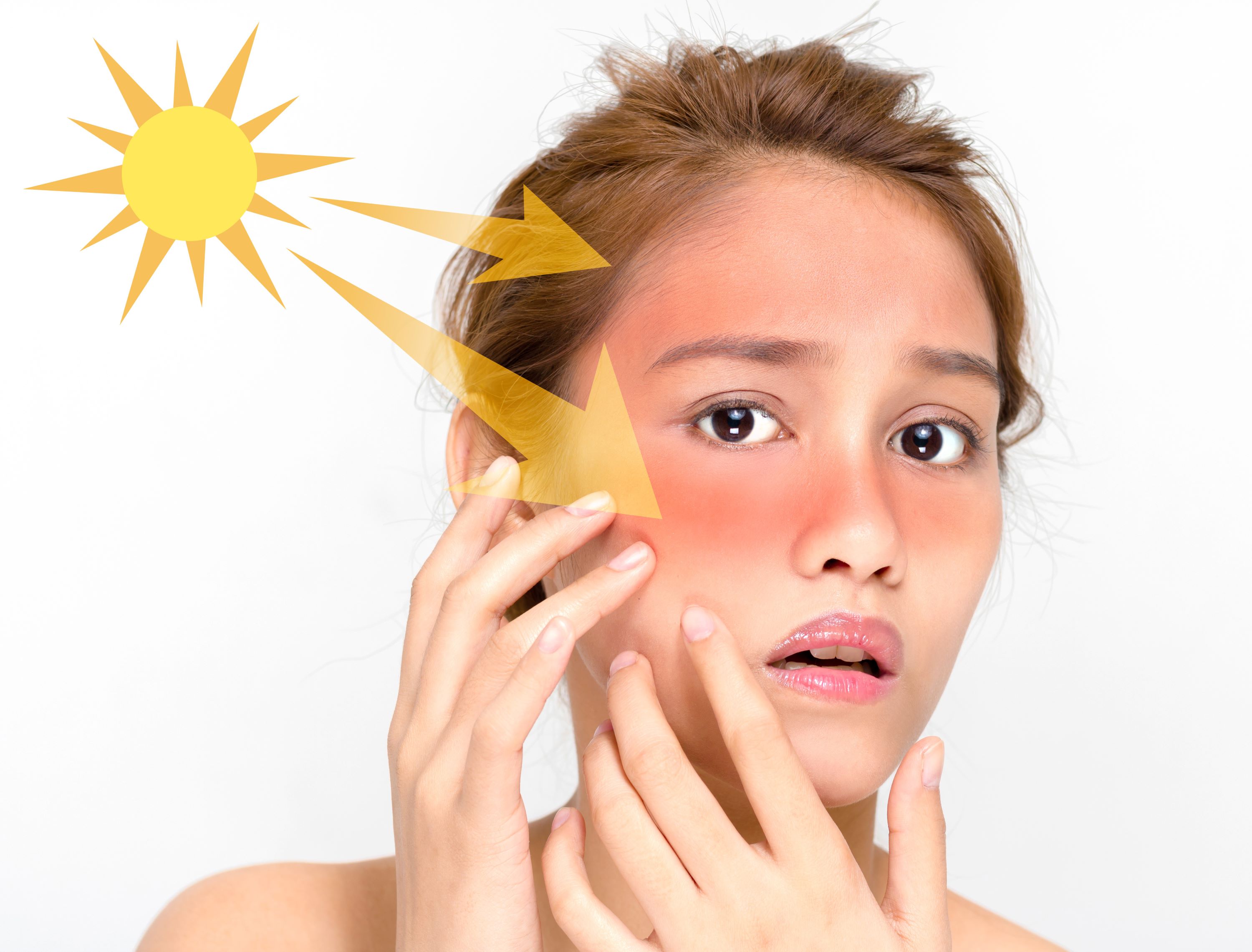 ¿Cómo prevenir y tratar las quemaduras solares?