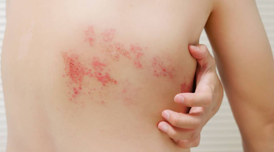 37% de personas sobre 50 años no les preocupa desarrollar herpes zóster