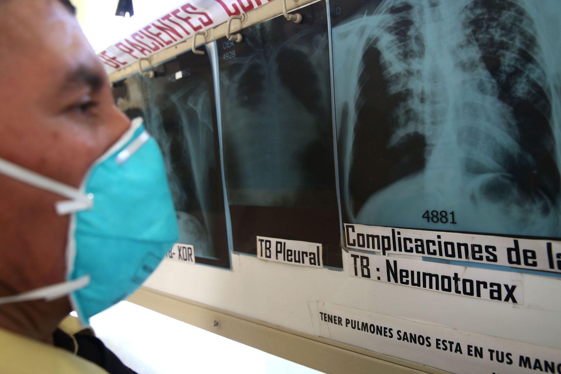 La nutrición juega un papel fundamental en la prevención y tratamiento de la TBC
