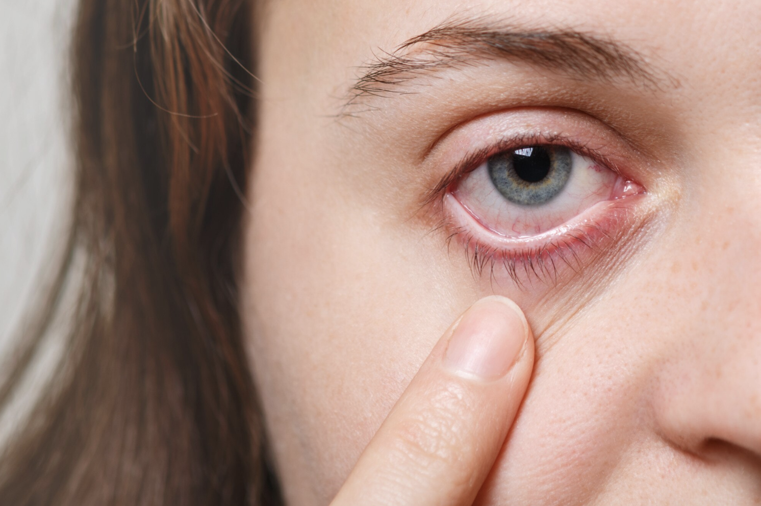 Conjuntivitis en verano: ¿Cómo evitarla? Recomendaciones de un oftalmólogo