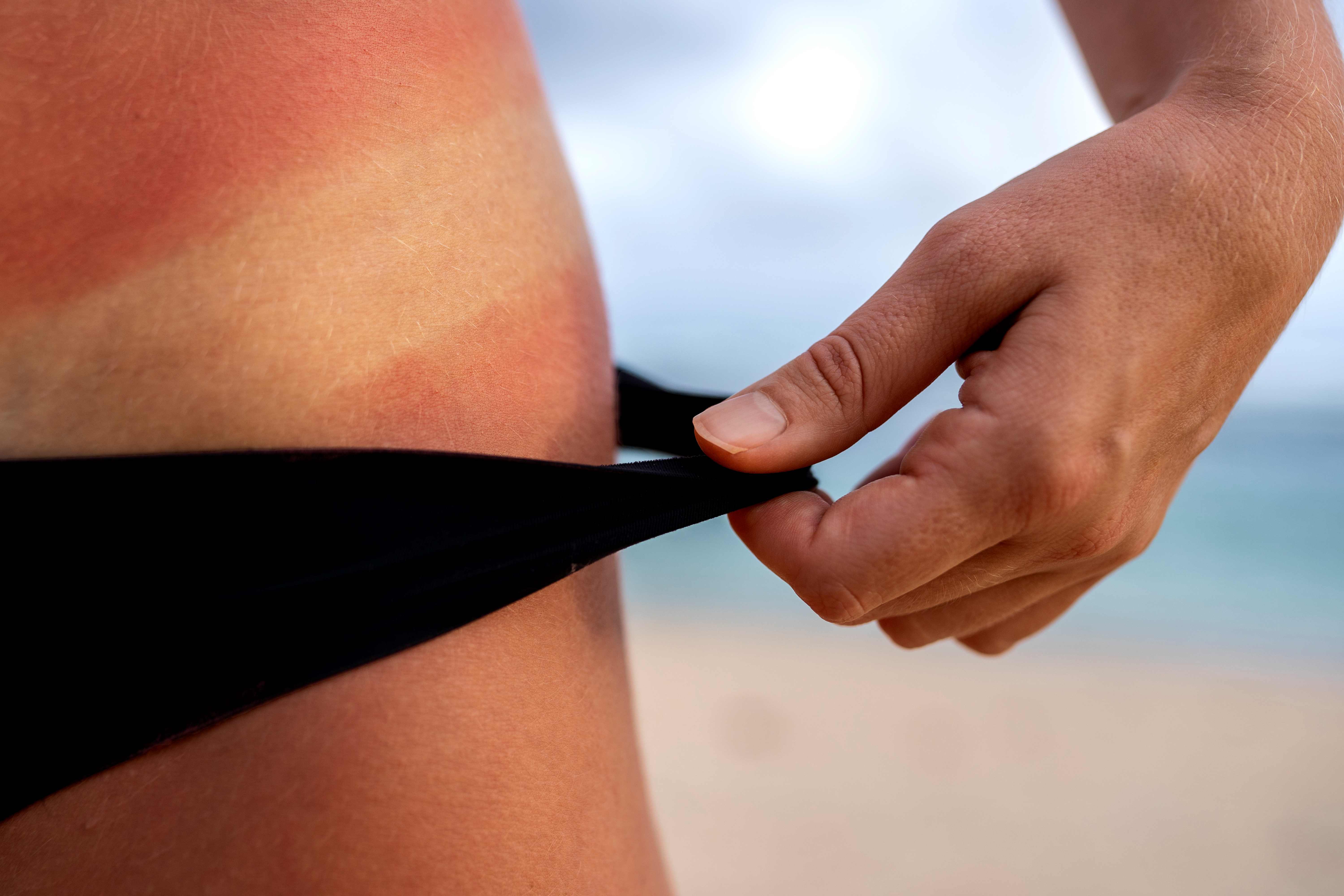 Primeros auxilios en verano: cómo actuar ante picaduras, quemaduras solares y accidentes acuáticos