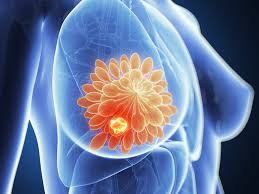 HER2-positivo: el subtipo más agresivo del cáncer de mama que aún enfrenta barreras en el acceso