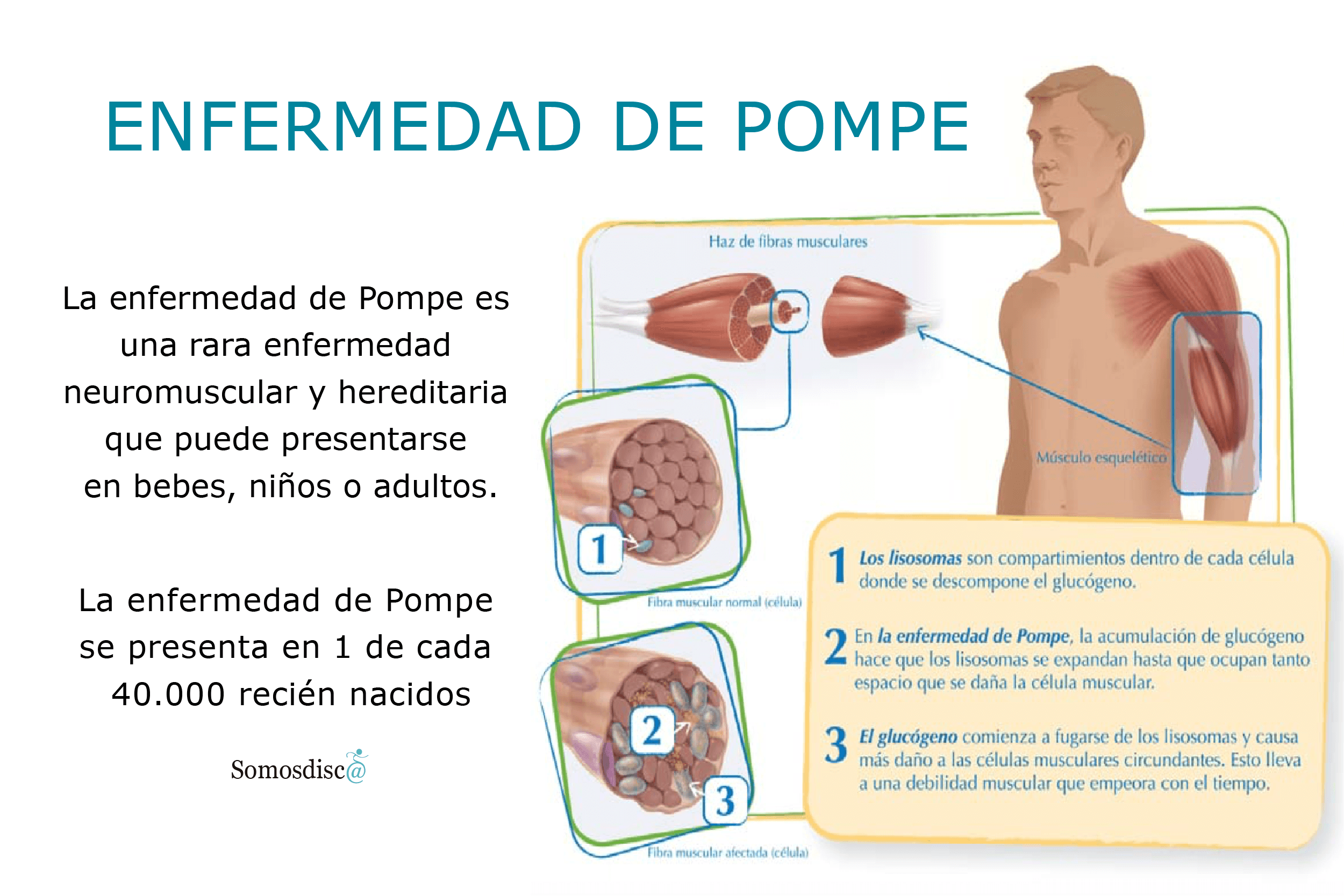 Capacitan a más de 200 profesionales de la salud en diagnóstico y tratamiento de la enfermedad de Pompe