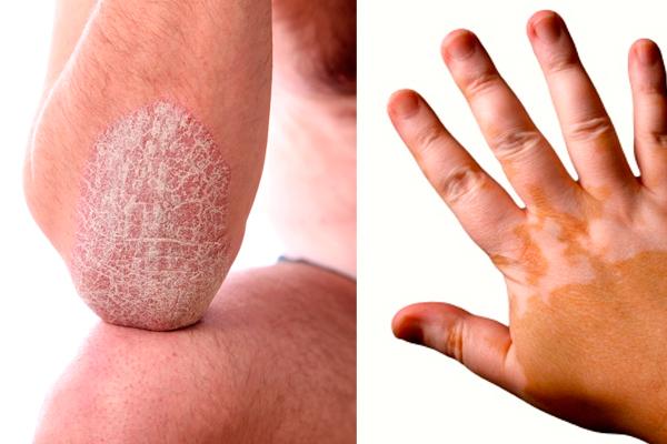 Vitiligo y psoriasis: cómo identificar las diferencias entre estas afecciones cutáneas