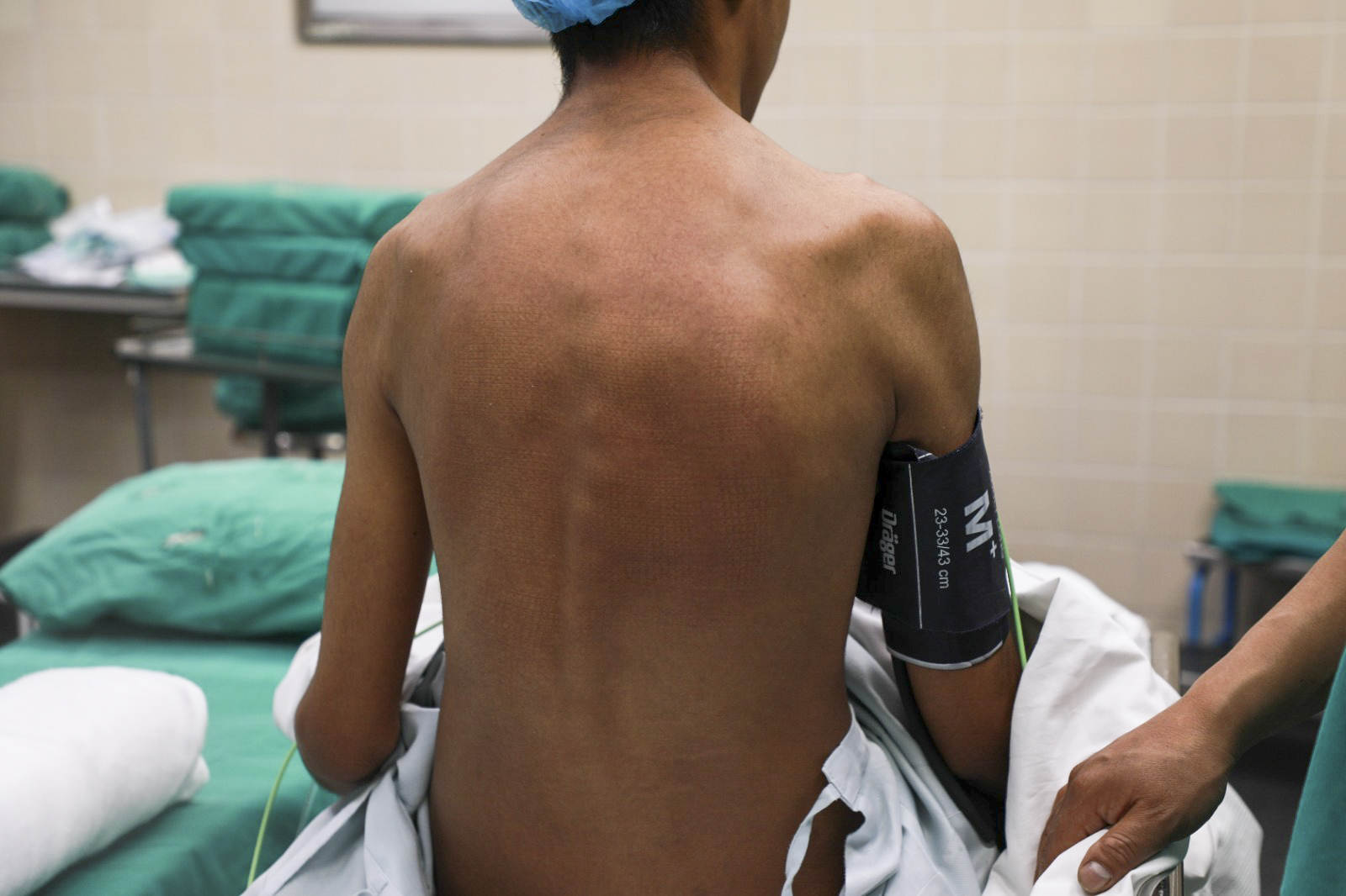 *Cusco: médicos de EsSalud corrigen columna de joven con tecnología 3D*
