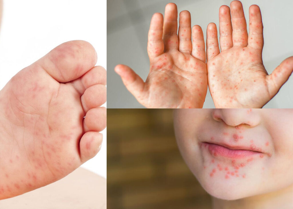“Mano, pies y boca”: ¿los niños generan inmunidad después de contagiarse?  