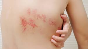 Herpes Zóster: Una enfermedad silenciosa y dolorosa que puede ser prevenida