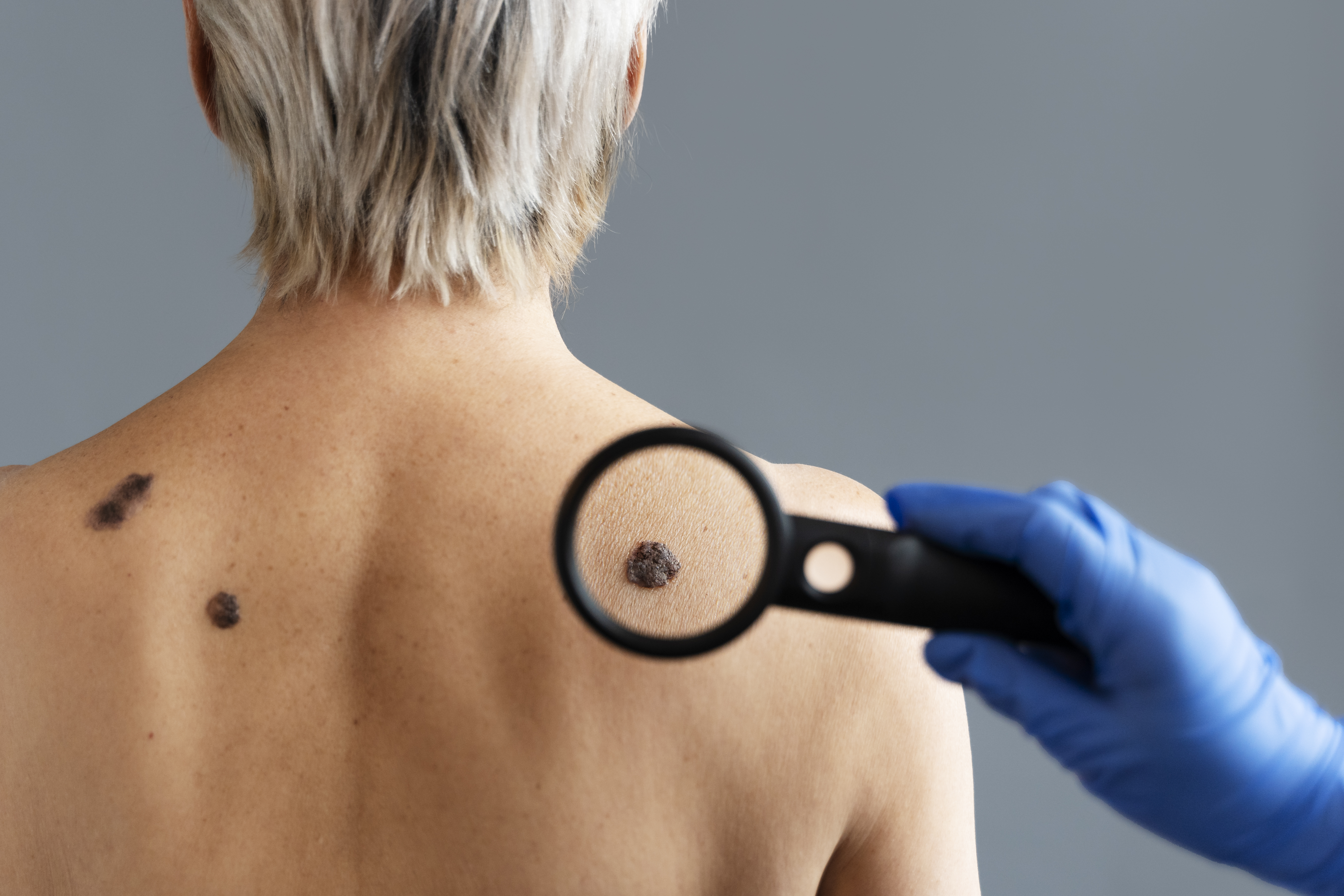 Trujillo: ¿Quiénes son más propensos a padecer cáncer de piel?  