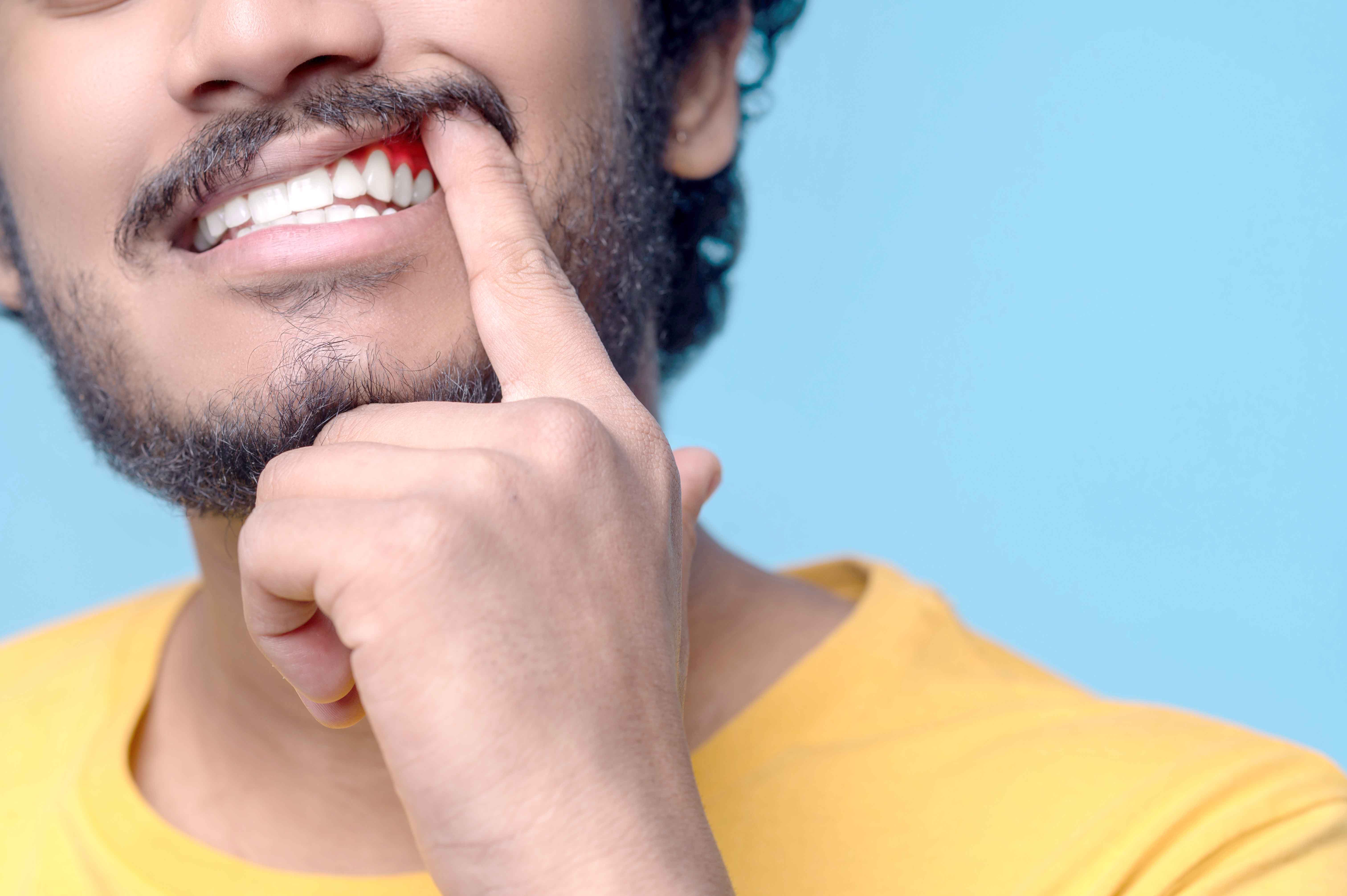 La alta prevalencia de microorganismos multirresistentes puede poner en riesgo el éxito de tratamientos periodontales