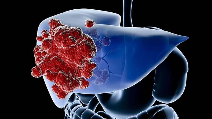 Cáncer de Hígado: Terapias podrían reducir el riesgo de muerte hasta en un 40%