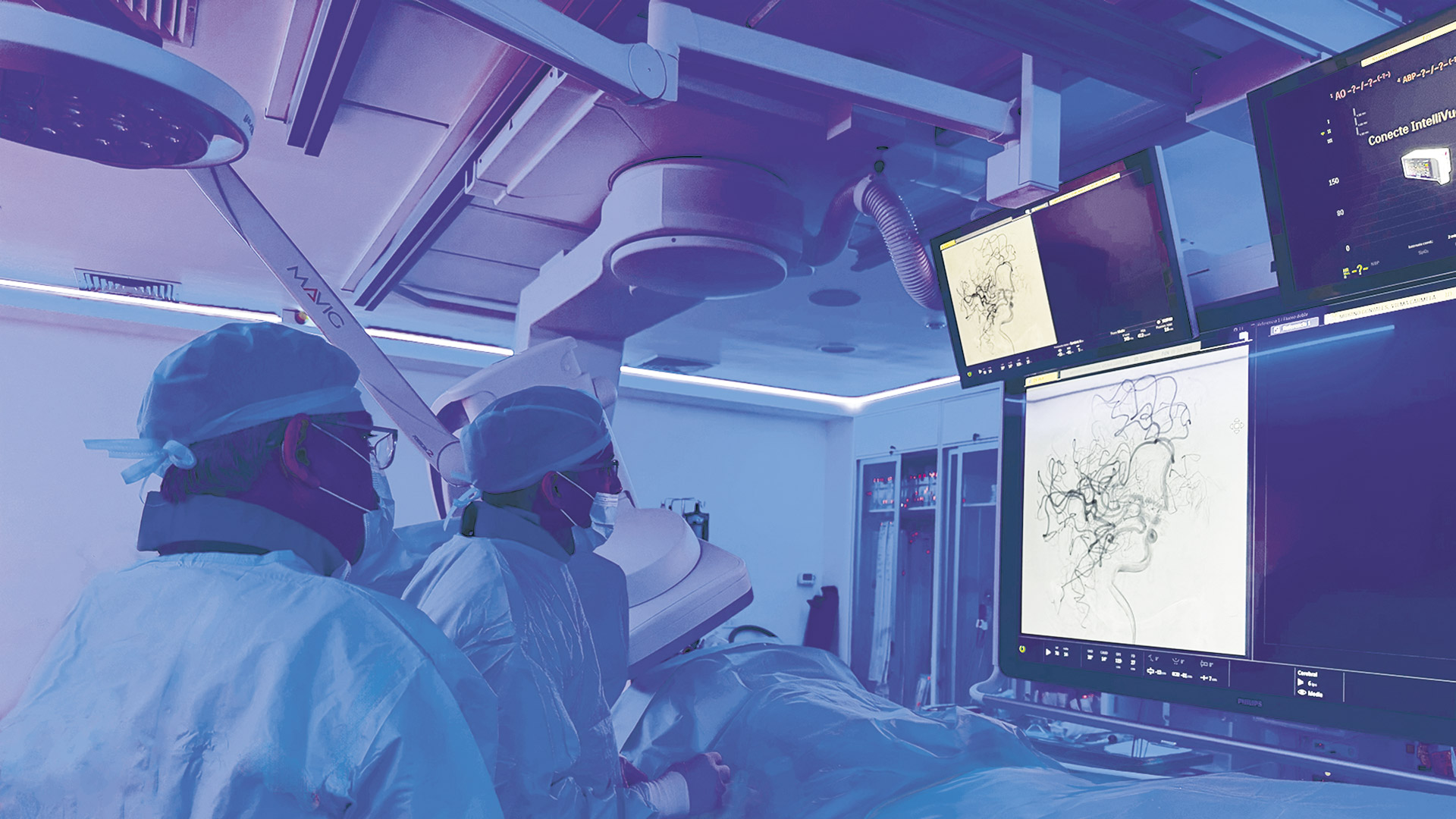 Avances en Neurocirugía Endovascular: ¿Cómo tratar enfermedades cerebrovasculares sin cirugías invasivas?