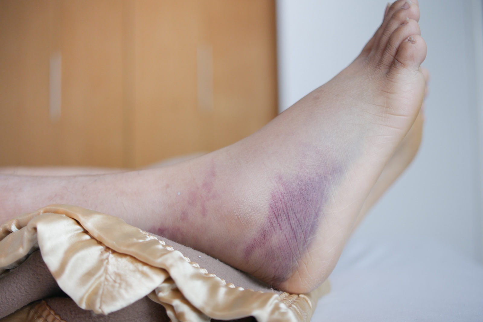La hemofilia en Perú: una infancia limitada por la falta de tratamiento oportuno