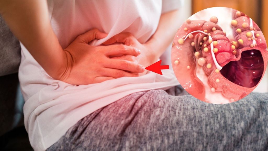 Hábitos para tener un colon sano y evitar los riesgos para desarrollar cáncer  