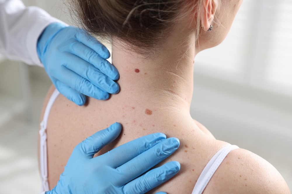Cinco señales en los lunares que podrían alertar sobre un cáncer de piel