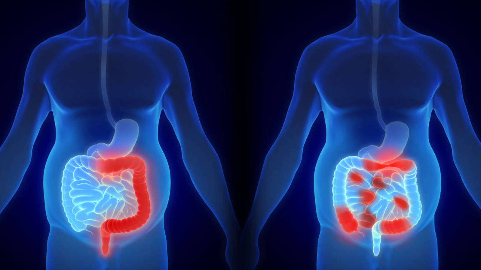 Pacientes con enfermedades inflamatorias intestinales son vulnerables a contraer coronavirus