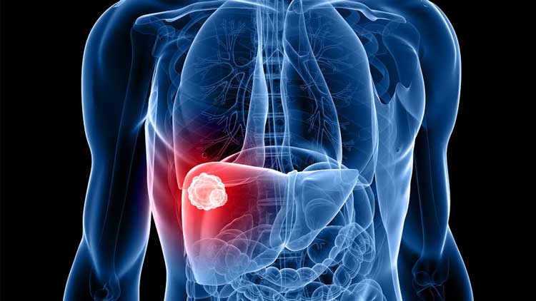 ¿Qué es la hepatitis y cómo prevenirla?